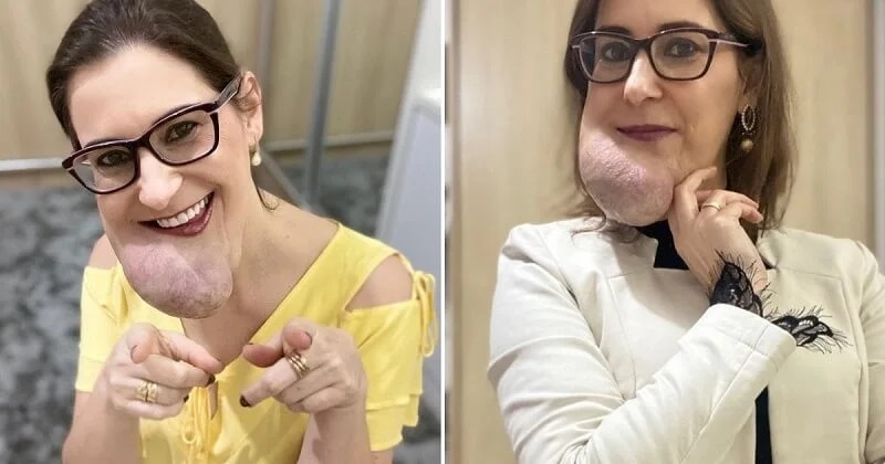 “I feel beautiful with my facial growth,” says woman with rare disorder
