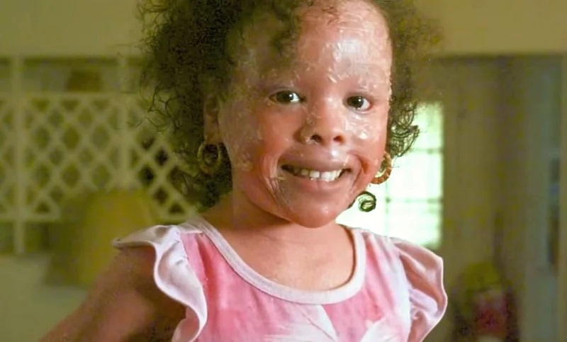 “She loves attention and is always happy” - the little girl whose skin is growing too fast