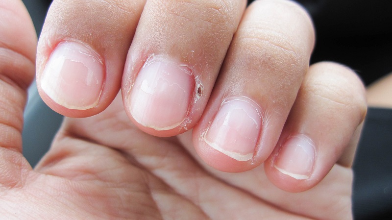 Why shredding skin around the nails can be so painful and how dangerous it is to tear it off
