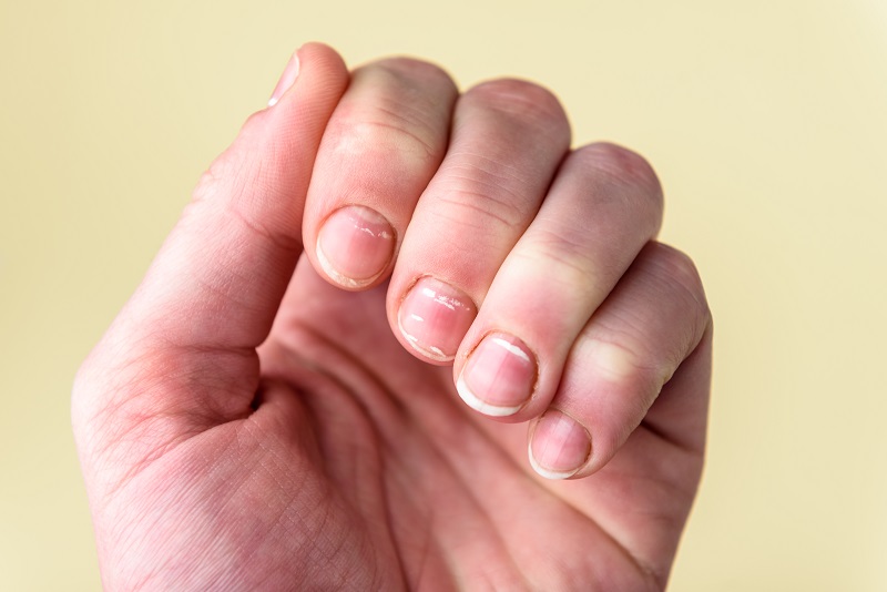What are white spots on nails? Conditions indicated by their appearance